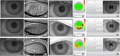 Ocular Manifestations and Neuropathy in Type 2 Diabetes Patients With Charcot Arthropathy